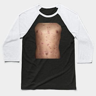 Chickenpox Baseball T-Shirt